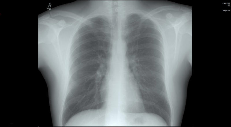Chest x-ray of the human body over a black background for coronavirus or Covid-19 concepts
